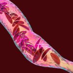 SickleCellAnemia SickleCellAnemia