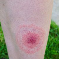 TickBite TickBite
